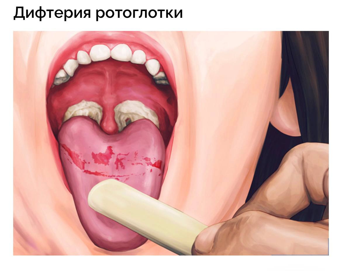 Дифтерия – что это за болезнь?