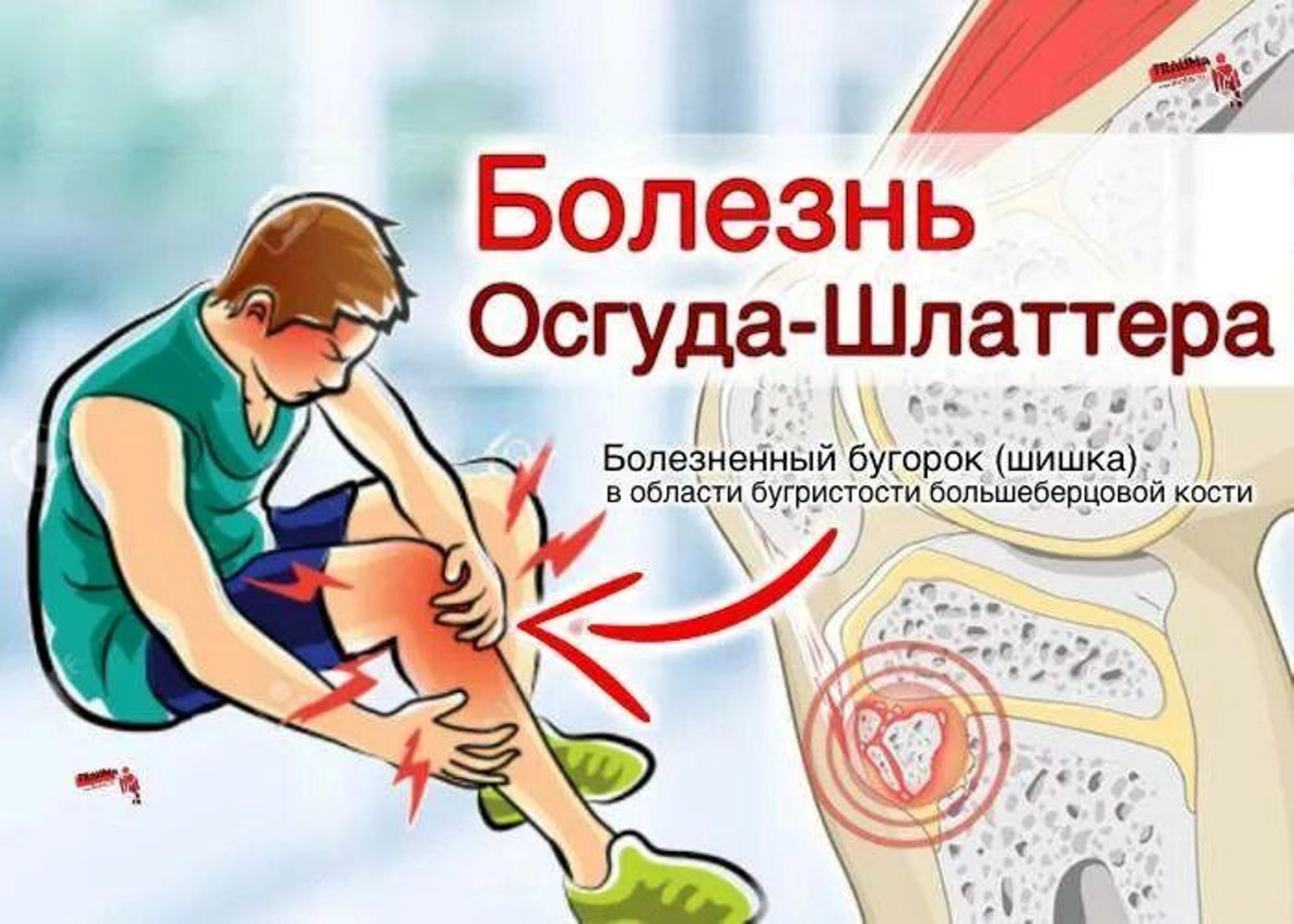 БОЛЕЗНЬ ОСГУДА-ШЛЯТТЕРА