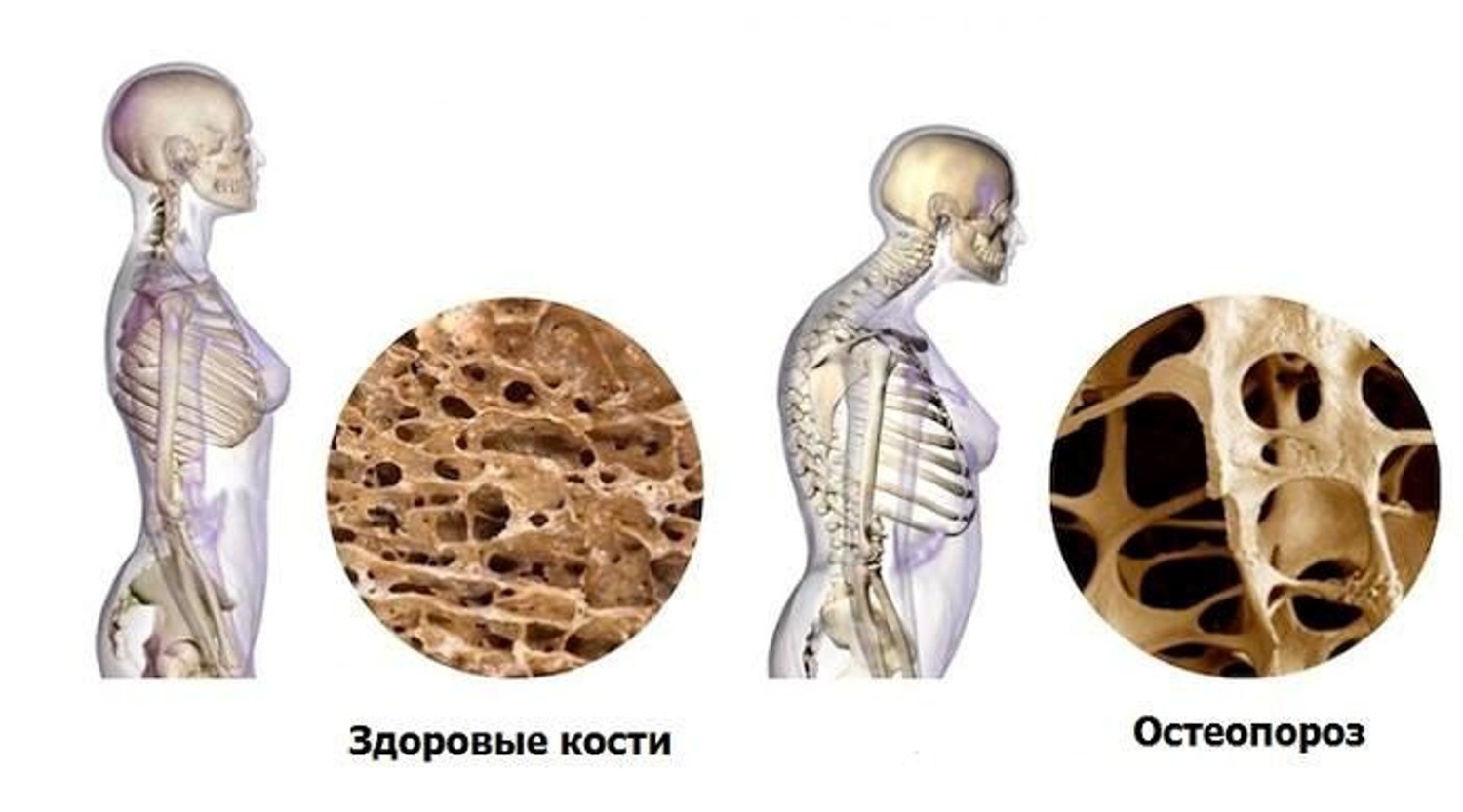 Что такое остеопороз?