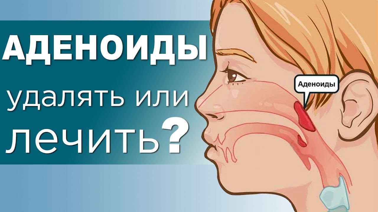 АДЕНОИДЫ ЛЕЧИТЬ ИЛИ УДАЛЯТЬ? АДЕНОИДЫ ЛЕЧИТЬ ИЛИ УДАЛЯТЬ?
