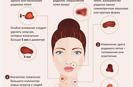 Меланома Меланома