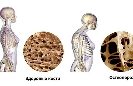 Что такое остеопороз? Что такое остеопороз?
