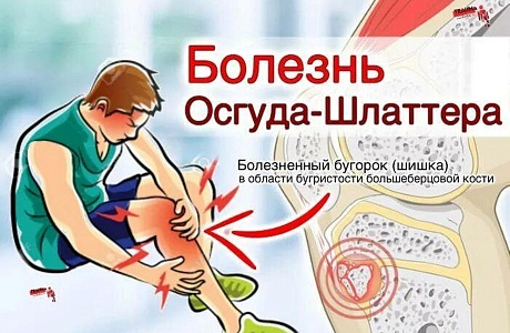 БОЛЕЗНЬ ОСГУДА-ШЛЯТТЕРА БОЛЕЗНЬ ОСГУДА-ШЛЯТТЕРА