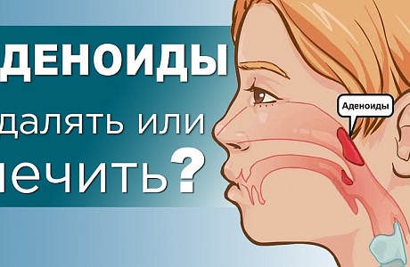 АДЕНОИДЫ ЛЕЧИТЬ ИЛИ УДАЛЯТЬ? АДЕНОИДЫ ЛЕЧИТЬ ИЛИ УДАЛЯТЬ?