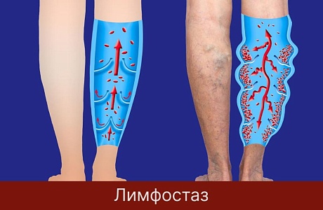 Лимфостаз